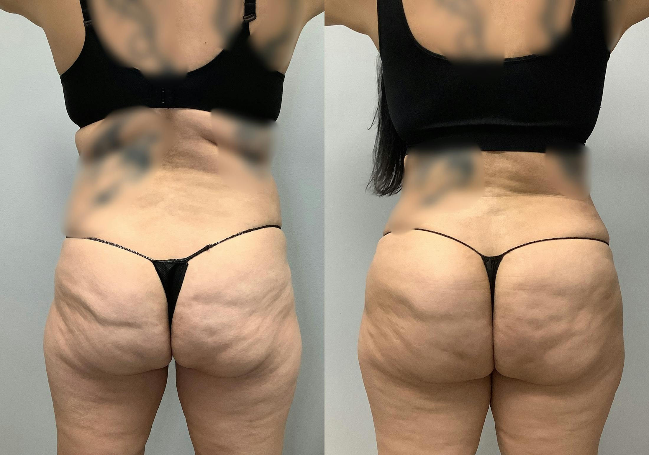 Brazilian Butt Lift Before & After Gallery - Patient 141595120 - Image 5
