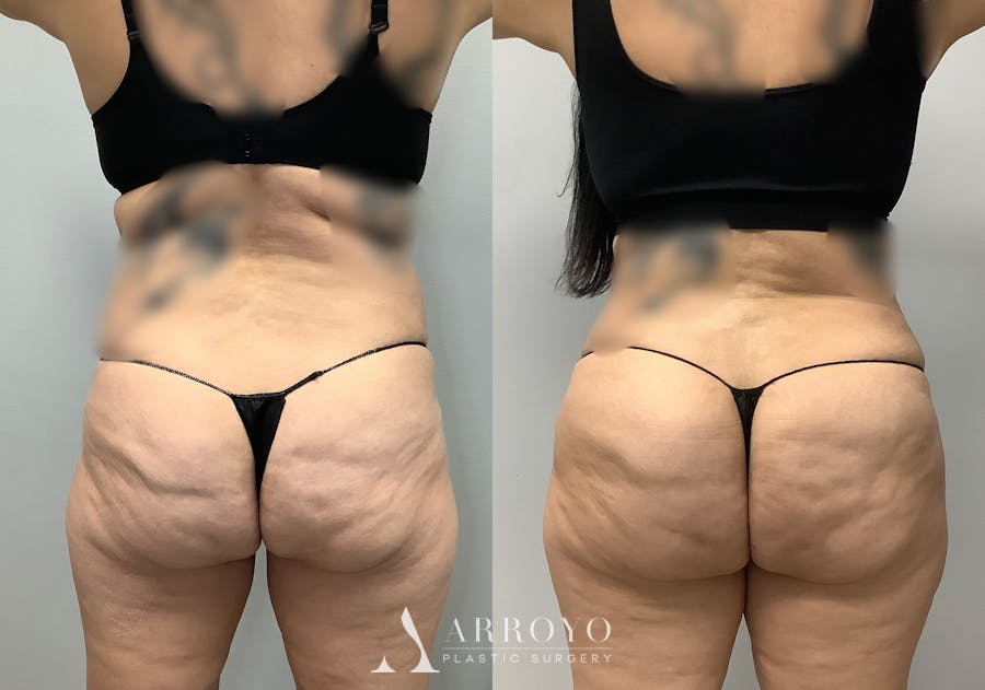 Brazilian Butt Lift Before & After Gallery - Patient 141595120 - Image 5
