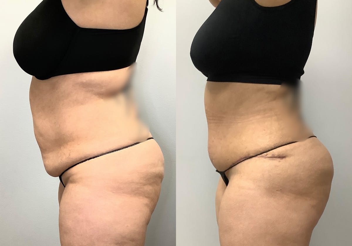 Brazilian Butt Lift Before & After Gallery - Patient 141595120 - Image 6