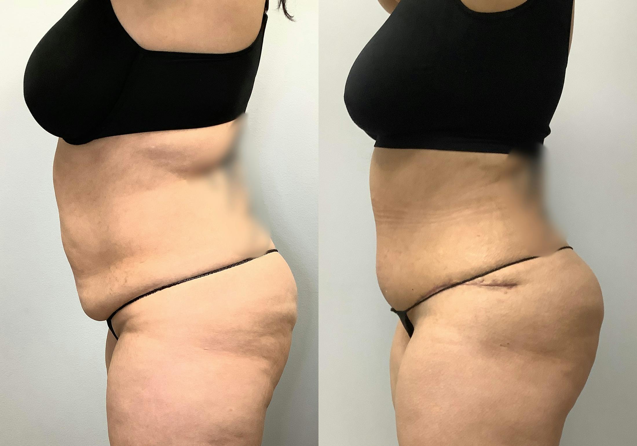 Liposuction Before & After Gallery - Patient 141595118 - Image 6