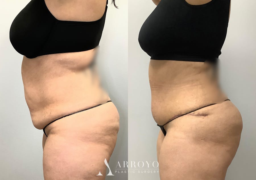 Brazilian Butt Lift Before & After Gallery - Patient 141595120 - Image 6