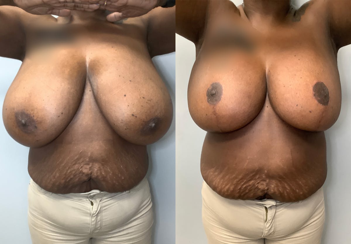 Breast Lift Before & After Gallery - Patient 141595090 - Image 1