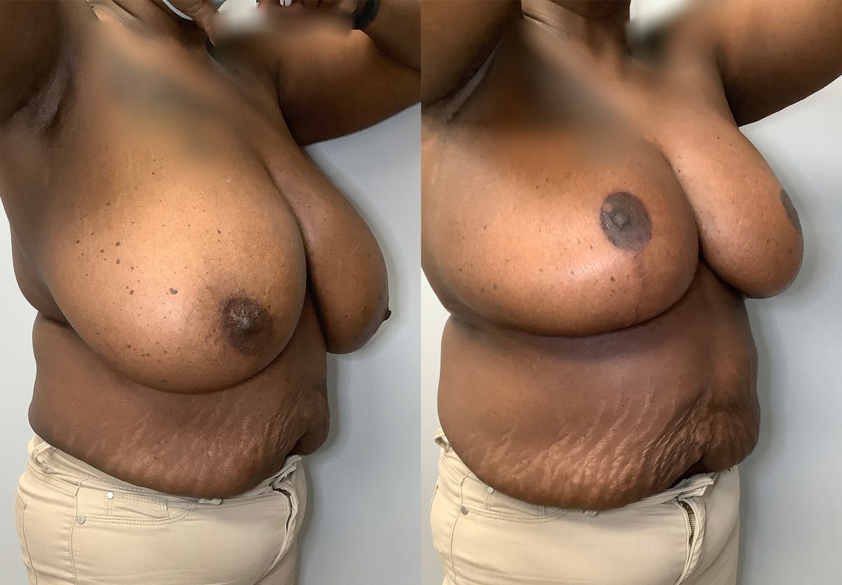 Breast Lift Before & After Gallery - Patient 141595090 - Image 2