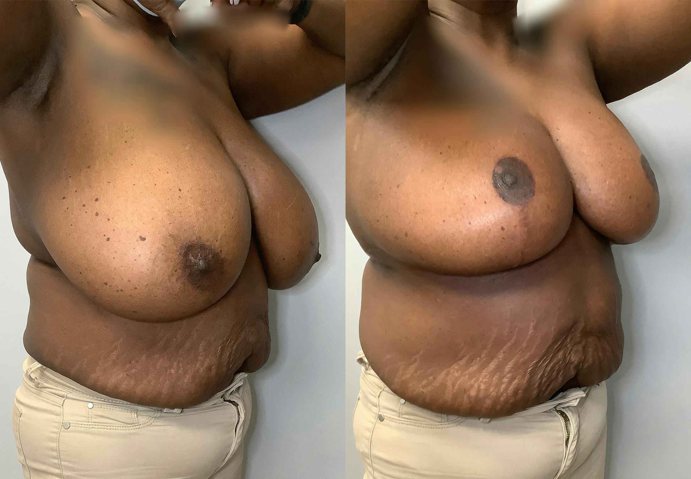 Breast Reduction Before & After Gallery - Patient 141595089 - Image 2