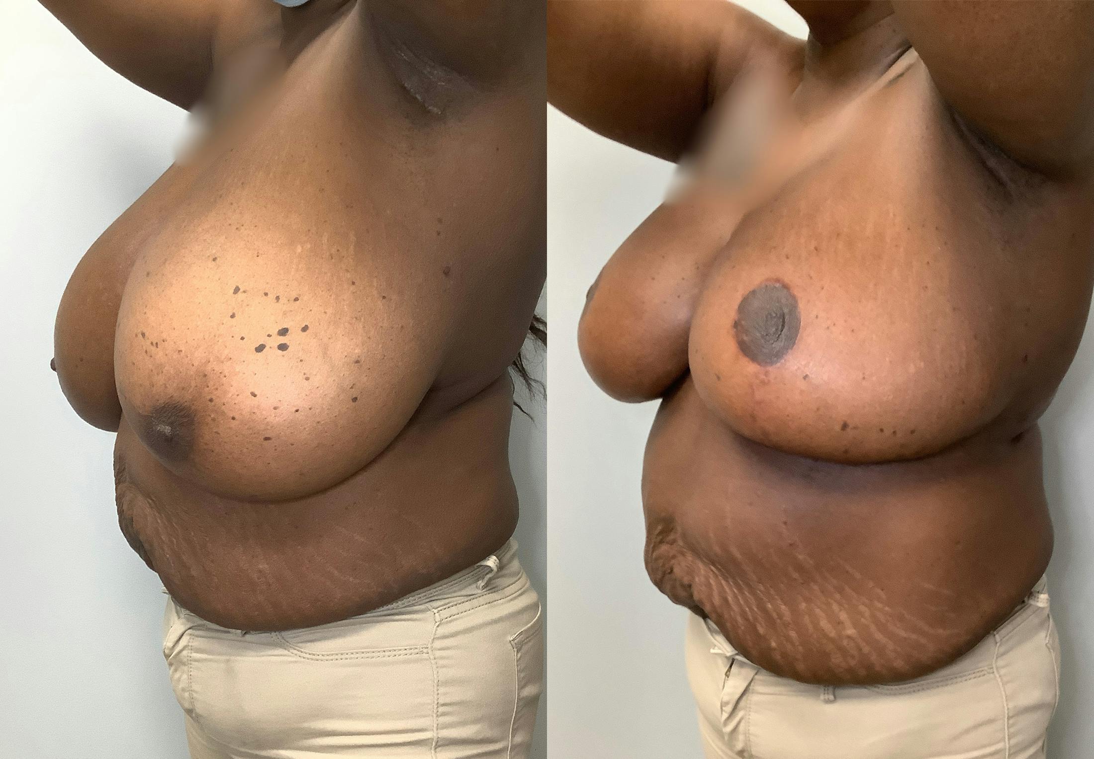 Breast Lift Before & After Gallery - Patient 141595090 - Image 4