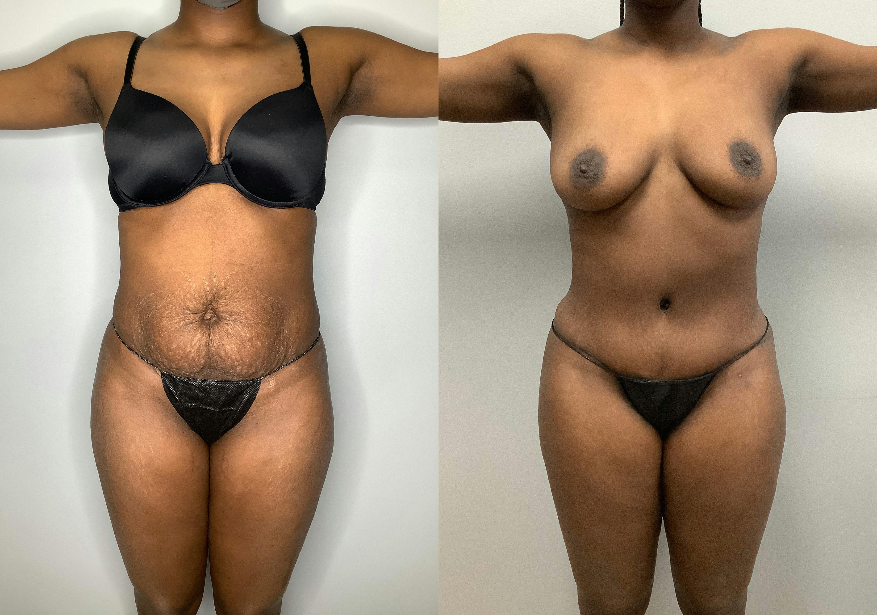 before and after of a Houston tummy tuck patient - 02