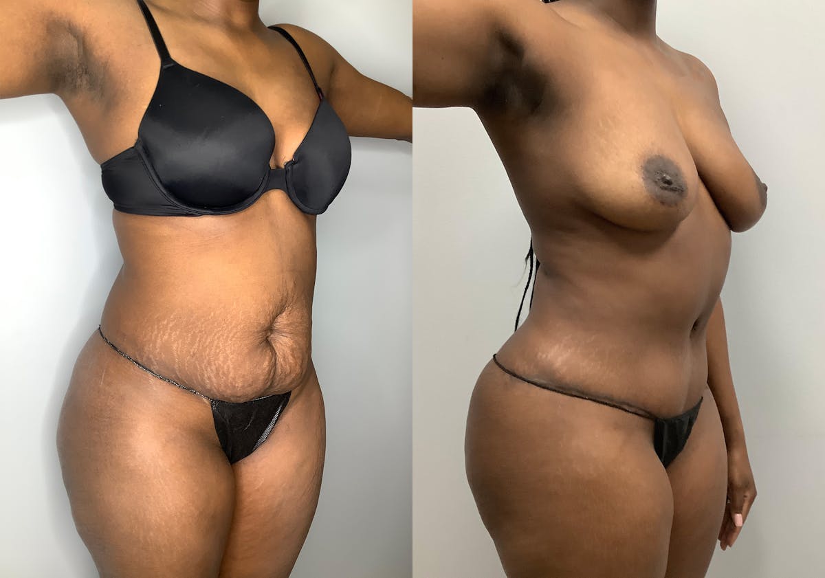 Tummy Tuck Before & After Gallery - Patient 147463777 - Image 2
