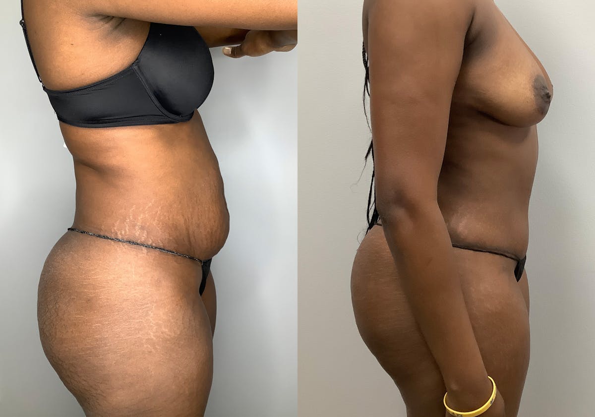 Tummy Tuck Before & After Gallery - Patient 147463777 - Image 3