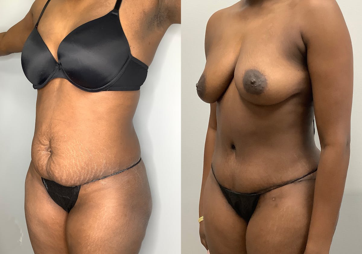 Tummy Tuck Before & After Gallery - Patient 147463777 - Image 4