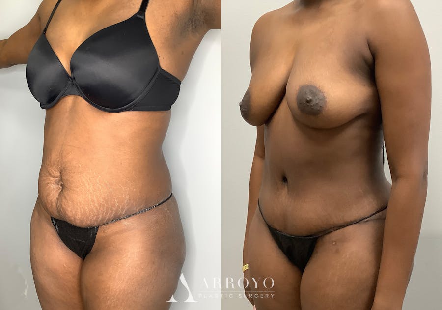 Tummy Tuck Before & After Gallery - Patient 147463777 - Image 4