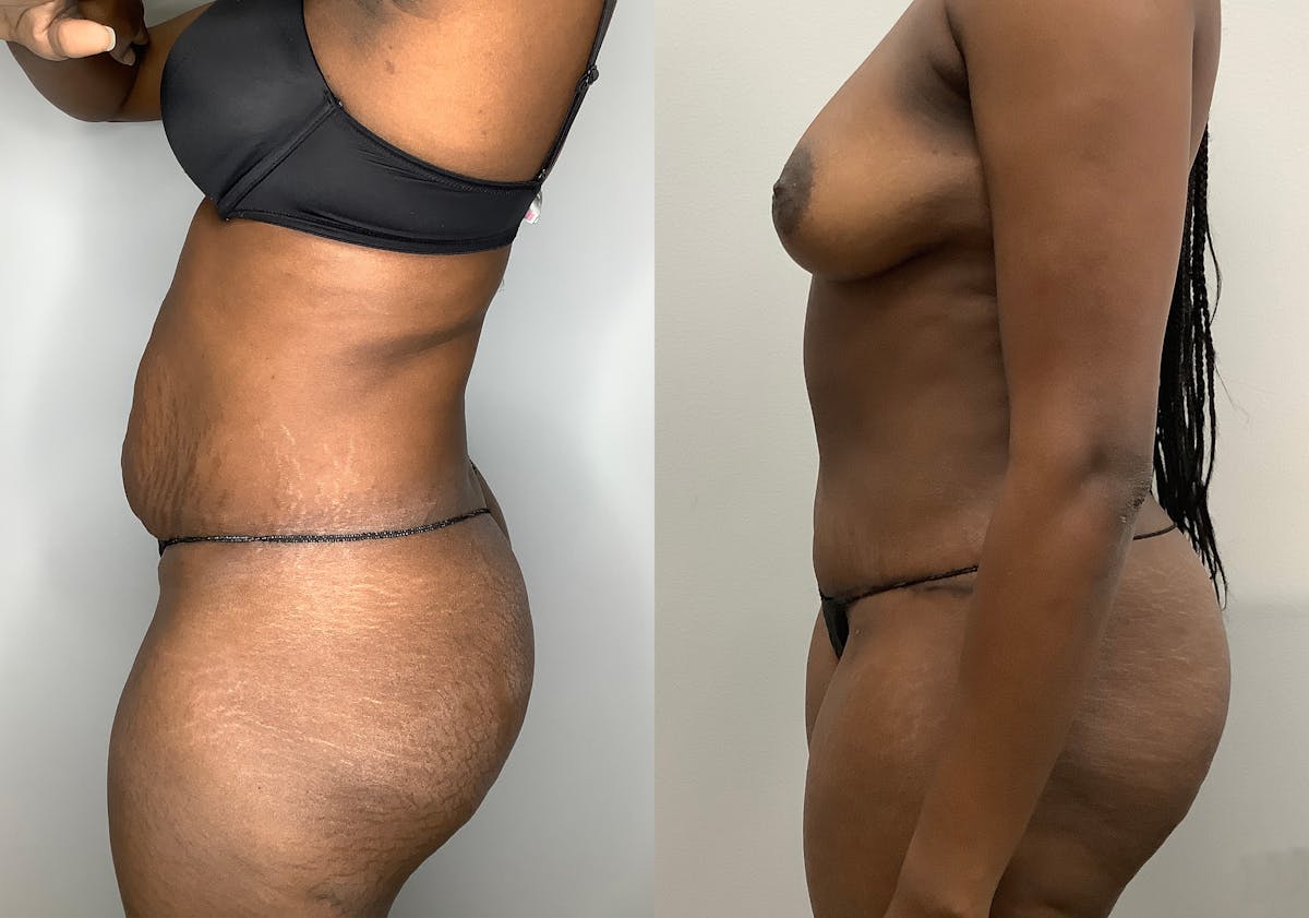 Tummy Tuck Before & After Gallery - Patient 147463777 - Image 5