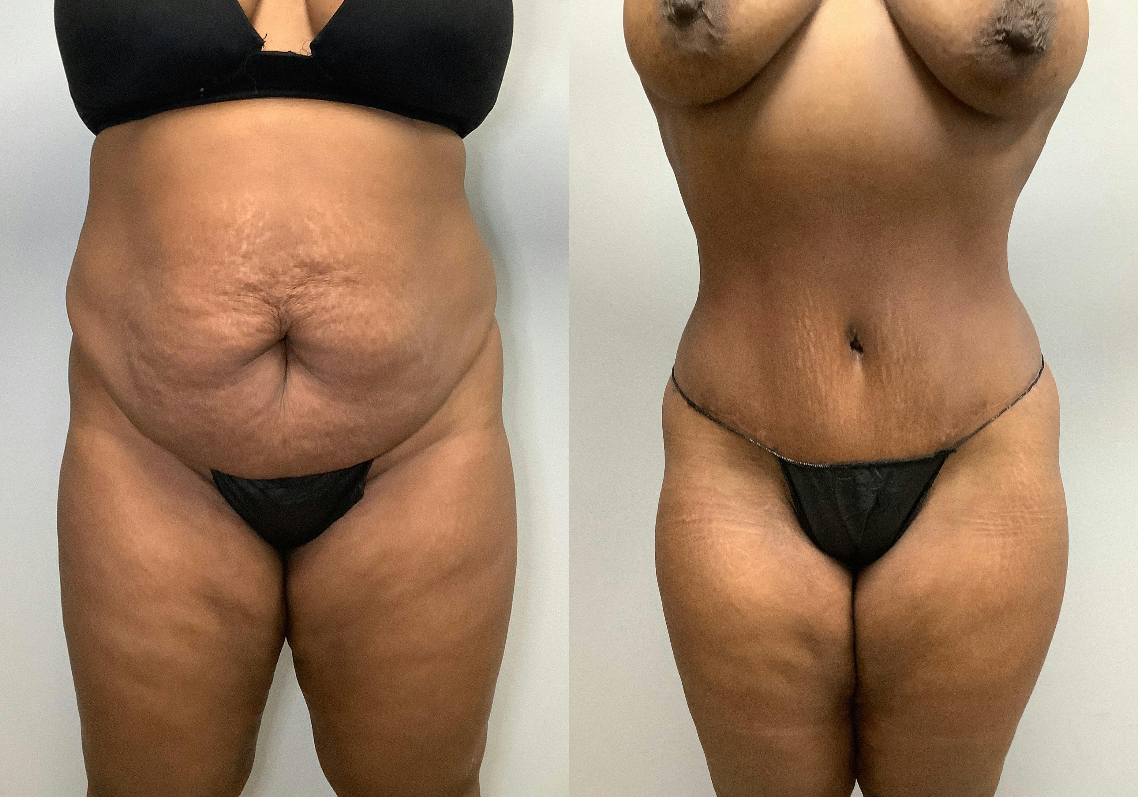 before and after of a Houston tummy tuck patient - 03