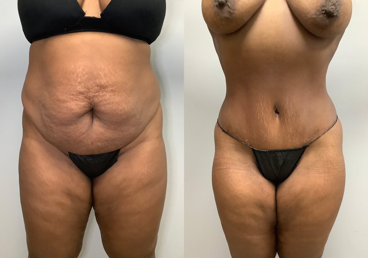 Tummy Tuck Before & After Gallery - Patient 147463804 - Image 1