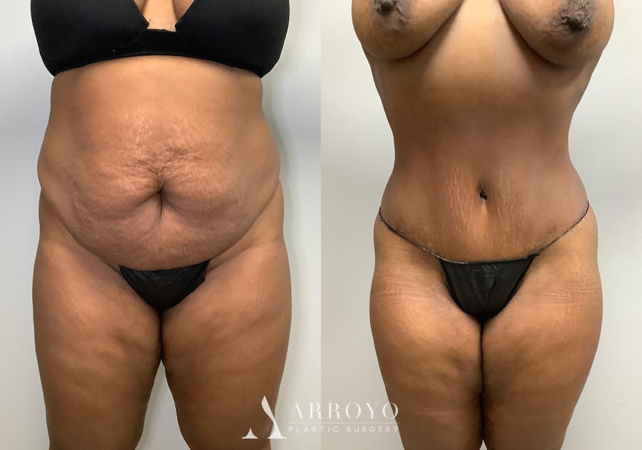 Tummy Tuck Before & After Gallery - Patient 147463804 - Image 1