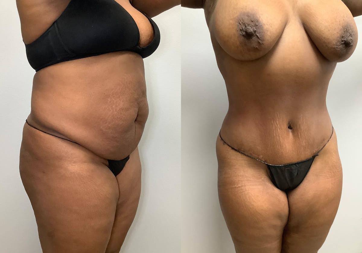 Tummy Tuck Before & After Gallery - Patient 147463804 - Image 2