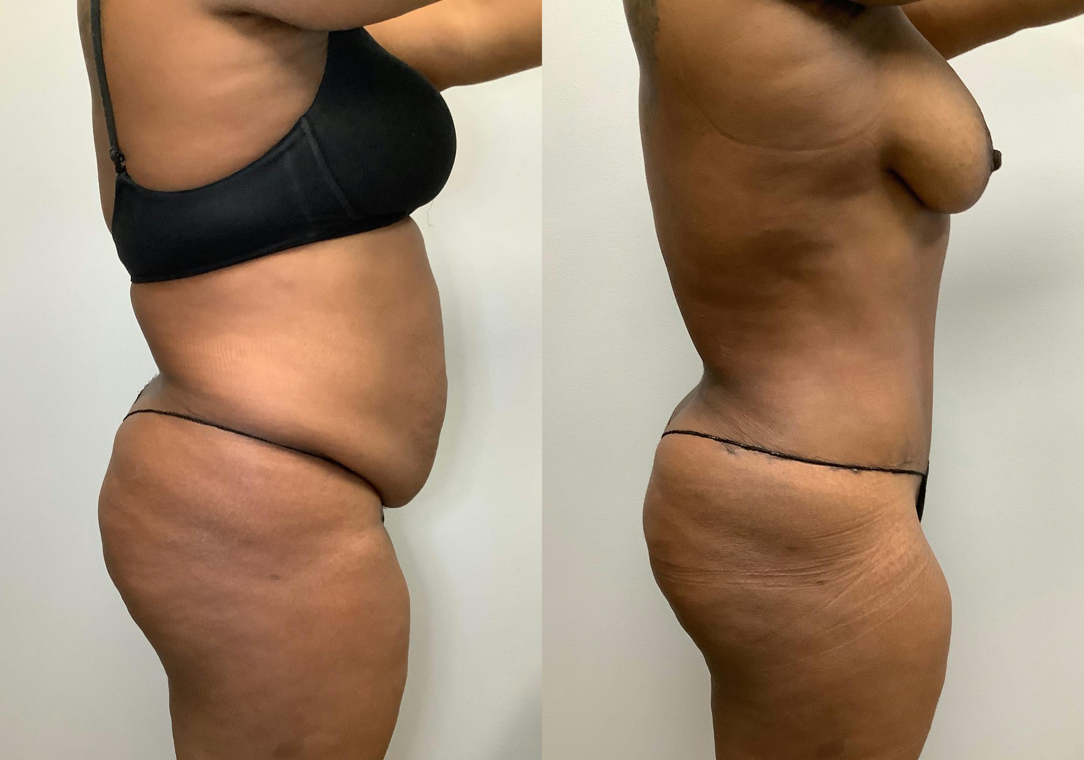 Tummy Tuck Before & After Gallery - Patient 147463804 - Image 3