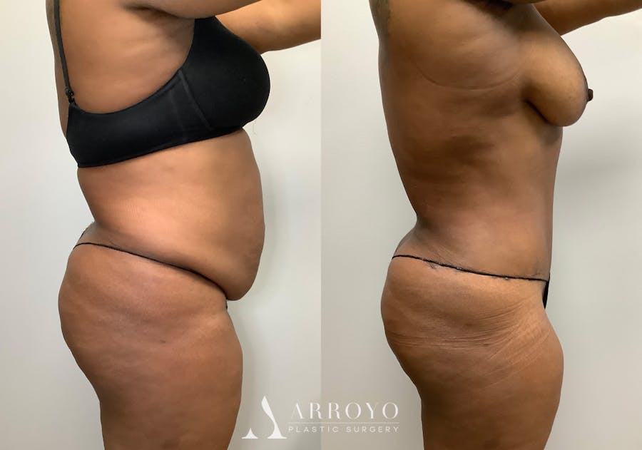Tummy Tuck Before & After Gallery - Patient 147463804 - Image 3