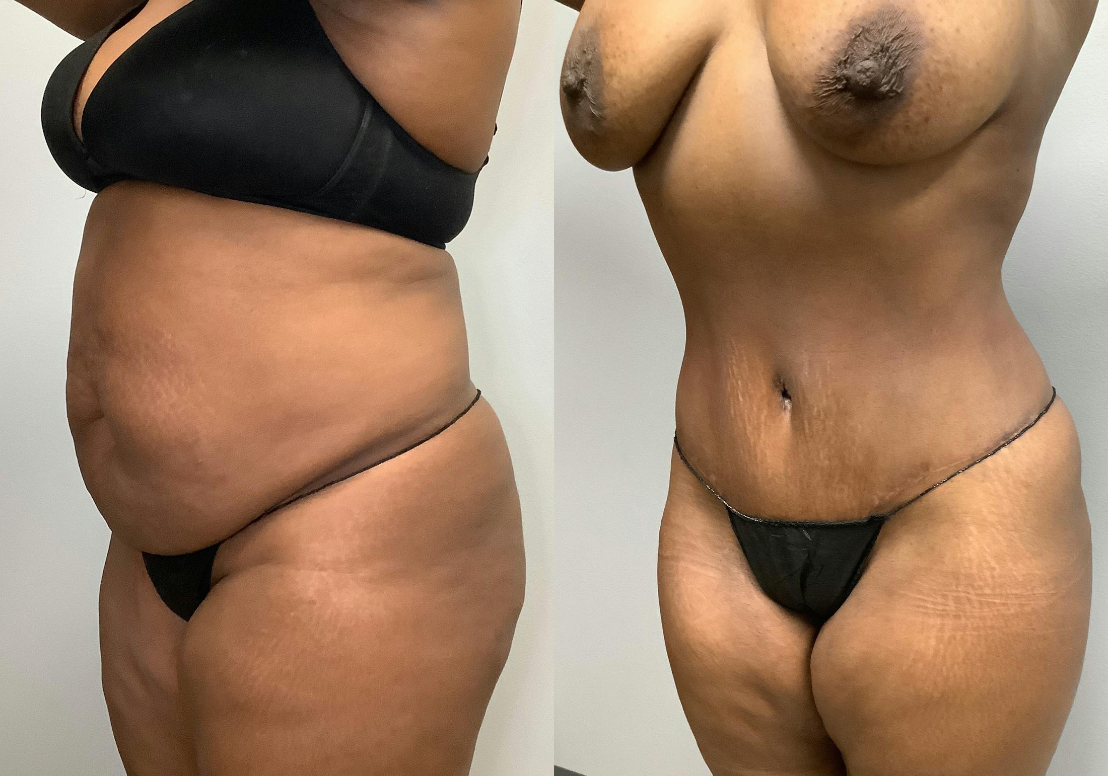 Tummy Tuck Before & After Gallery - Patient 147463804 - Image 4