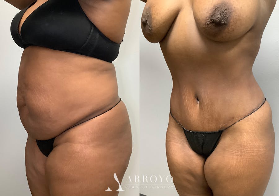 Tummy Tuck Before & After Gallery - Patient 147463804 - Image 4