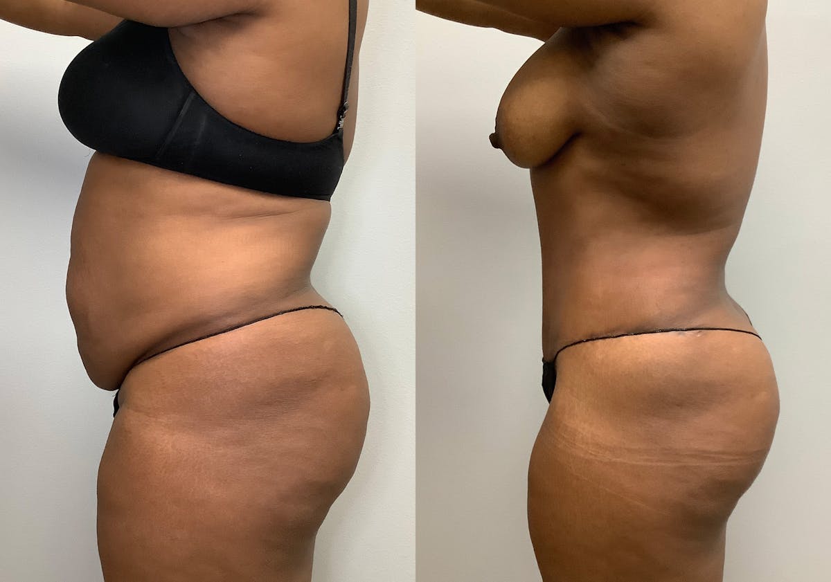 Tummy Tuck Before & After Gallery - Patient 147463804 - Image 5
