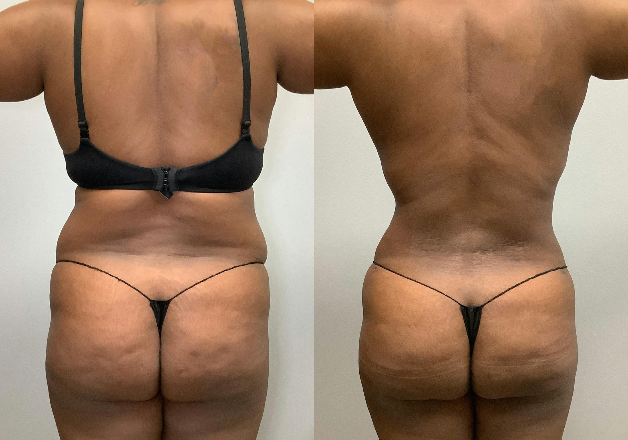 Tummy Tuck Before & After Gallery - Patient 147463804 - Image 6