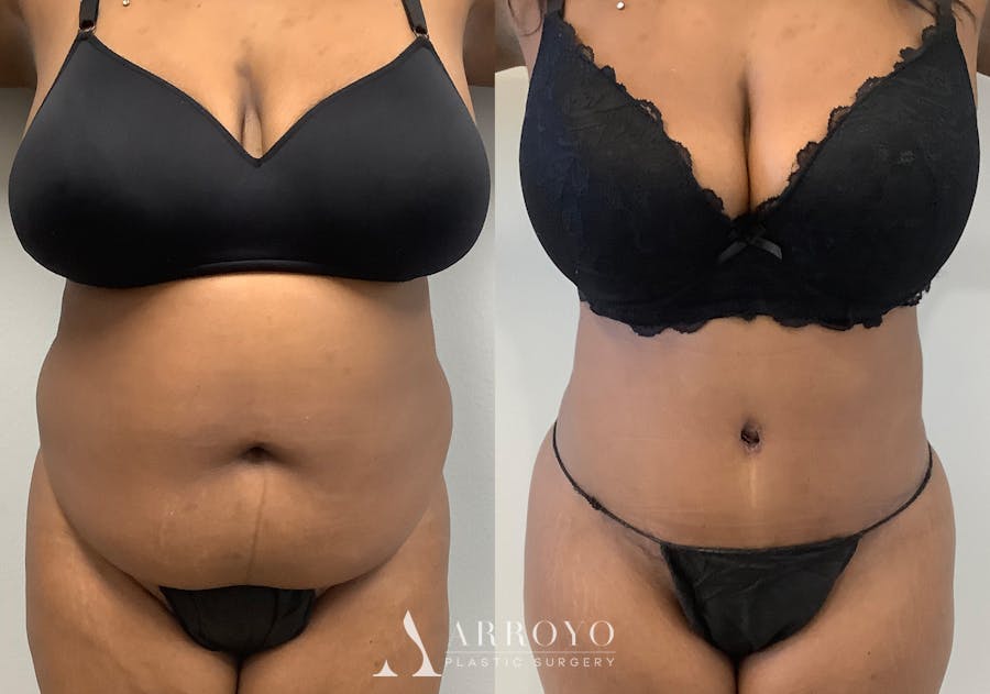 Tummy Tuck Before & After Gallery - Patient 147463805 - Image 1