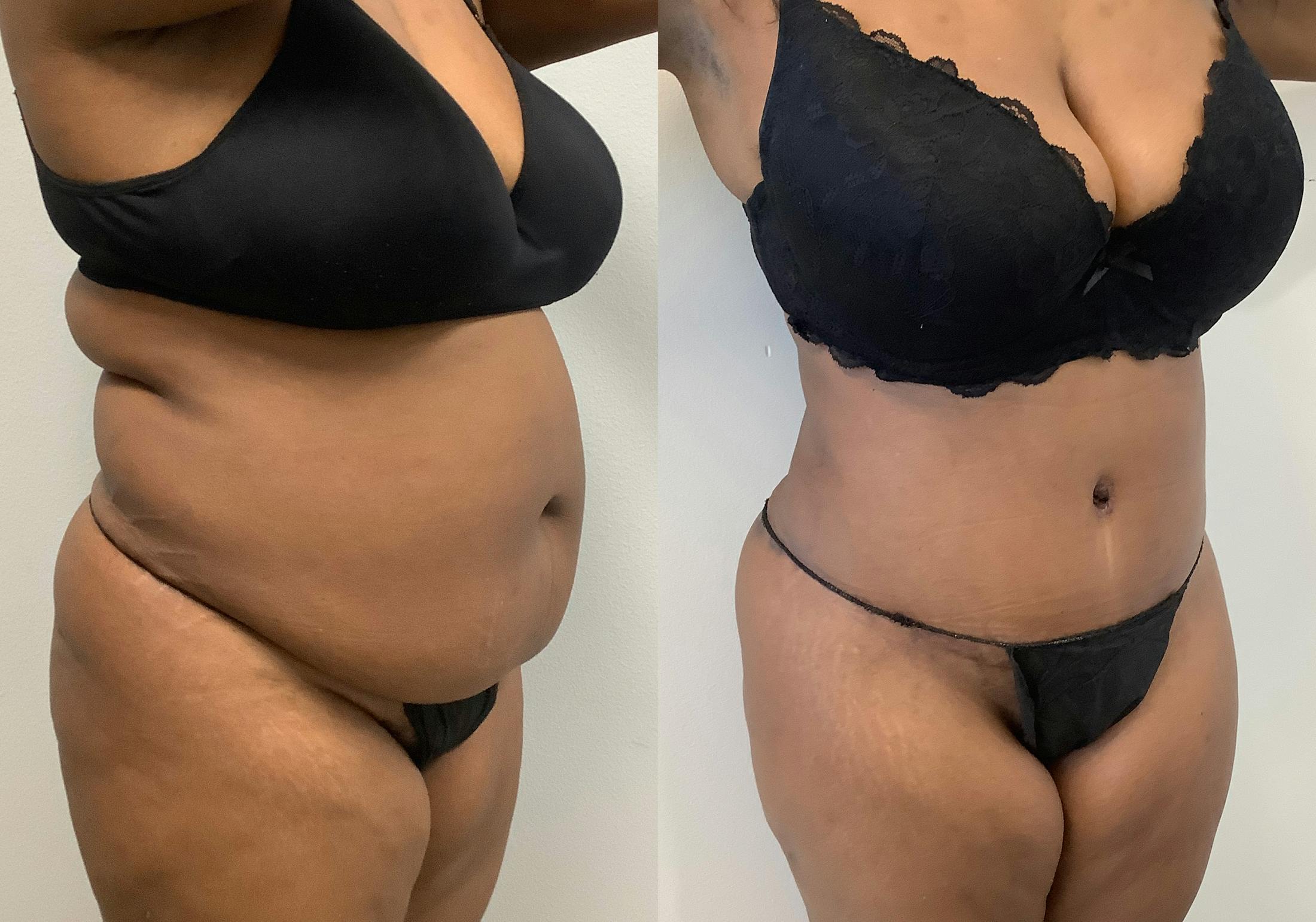 Tummy Tuck Before & After Gallery - Patient 147463805 - Image 2