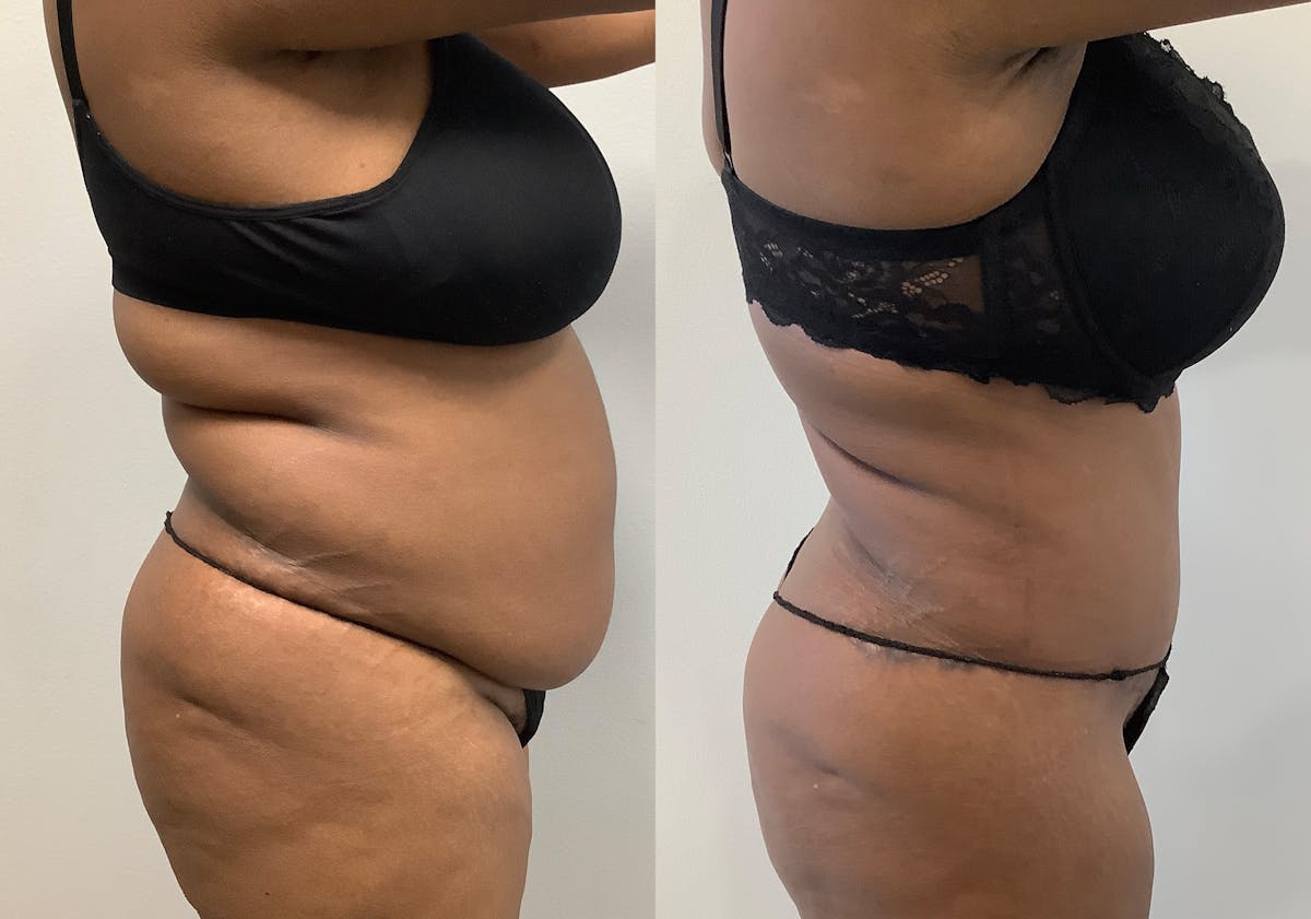 Tummy Tuck Before & After Gallery - Patient 147463805 - Image 3