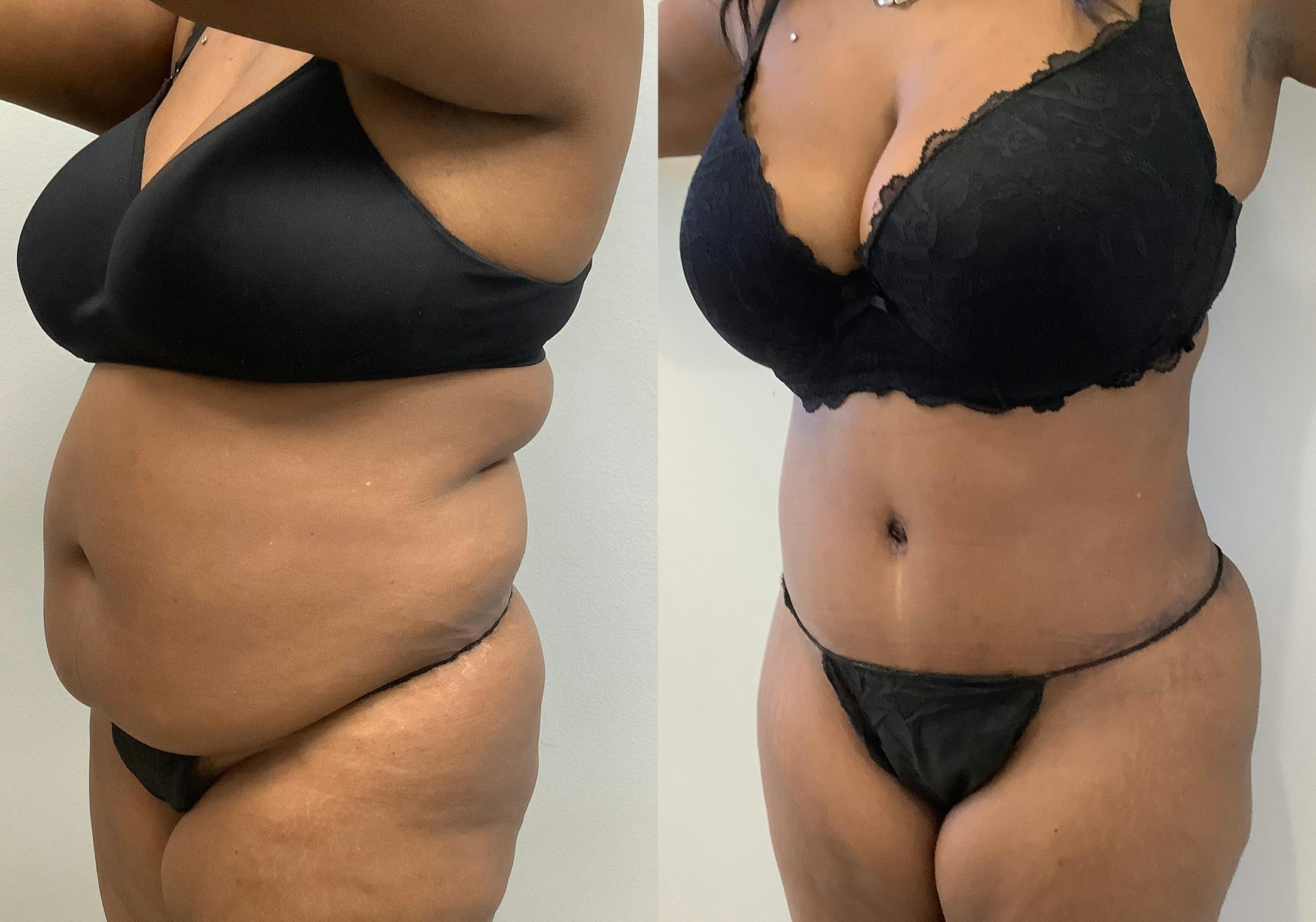 Tummy Tuck Before & After Gallery - Patient 147463805 - Image 4