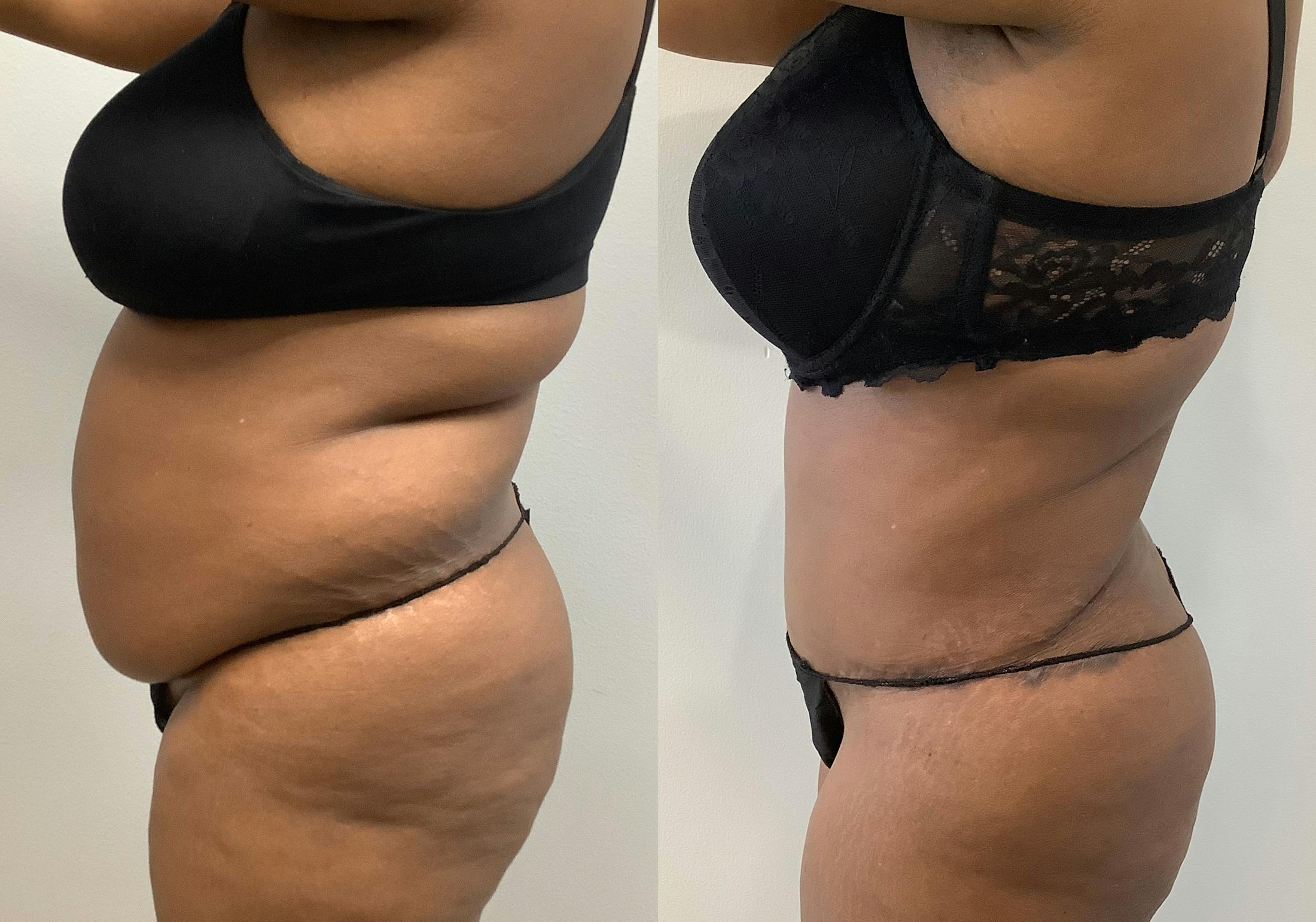 Tummy Tuck Before & After Gallery - Patient 147463805 - Image 5