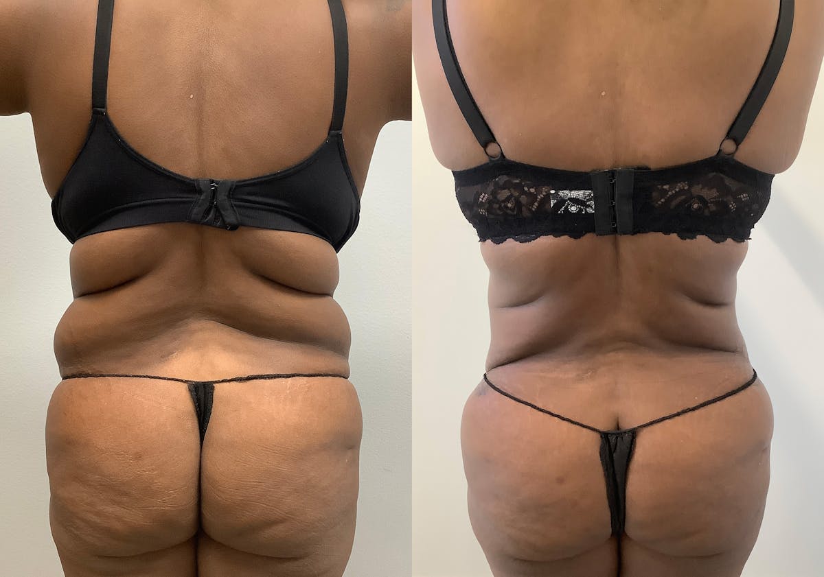 Tummy Tuck Before & After Gallery - Patient 147463805 - Image 6