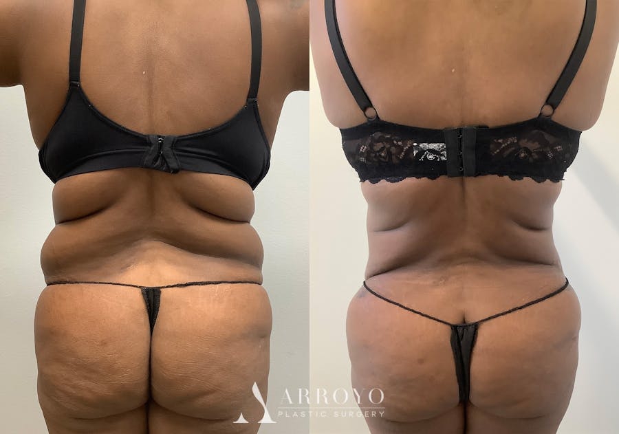 Tummy Tuck Before & After Gallery - Patient 147463805 - Image 6