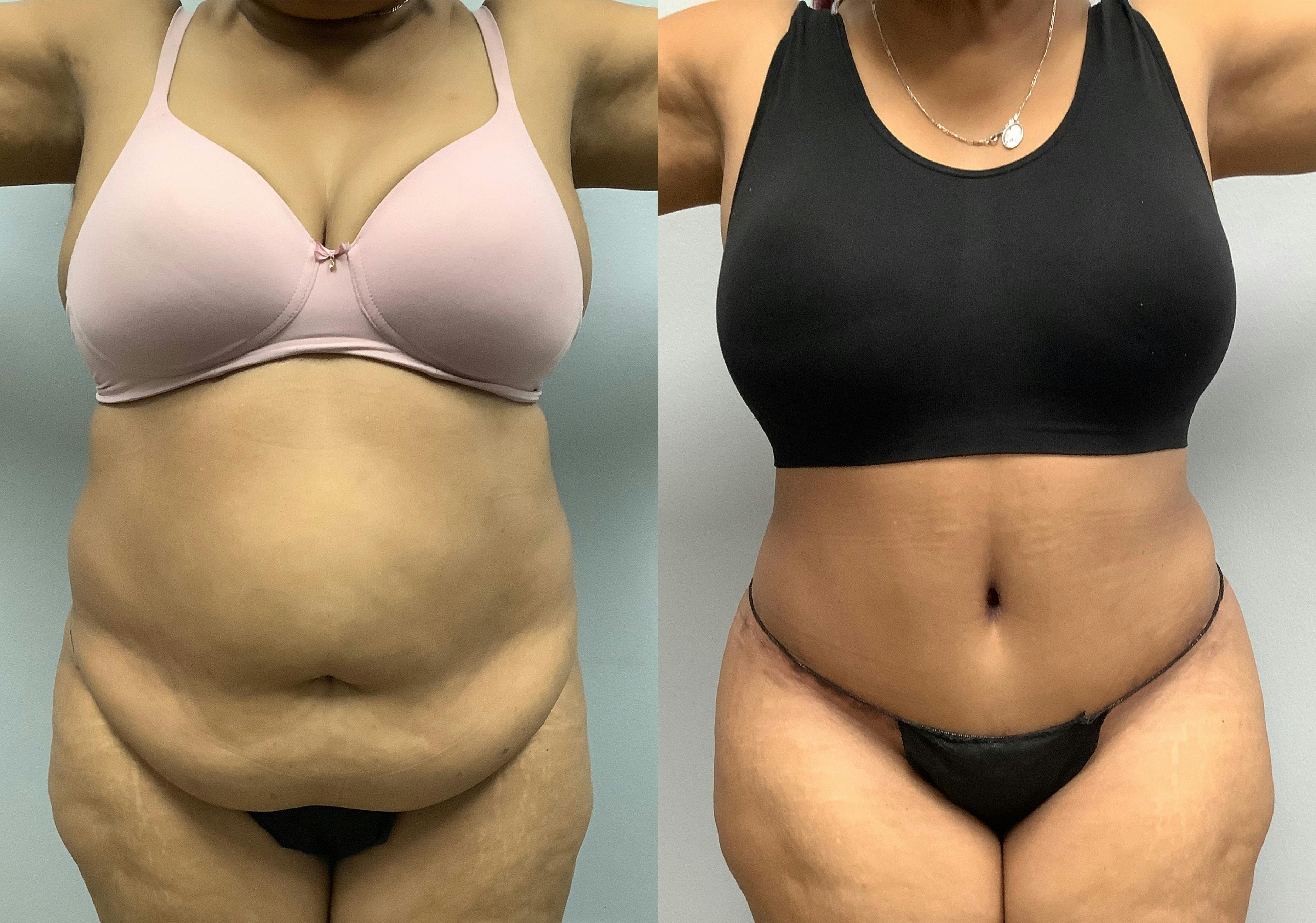 before and after of a Houston tummy tuck patient - 04