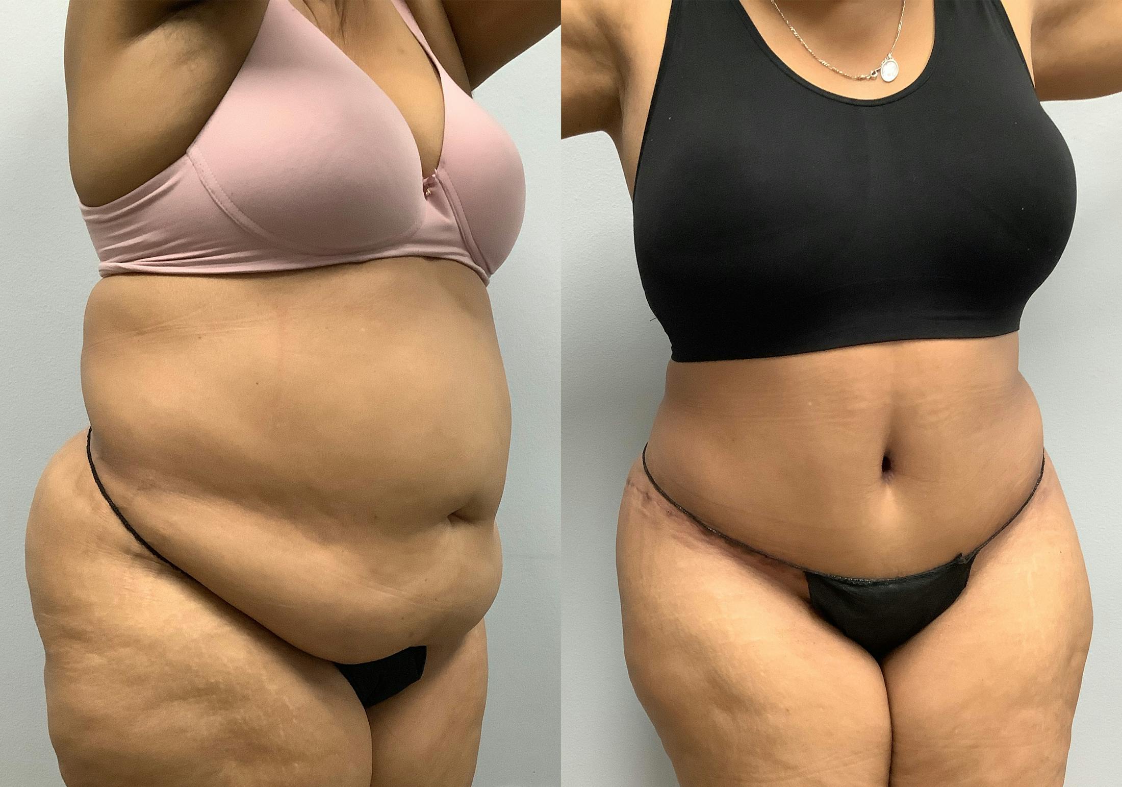 Tummy Tuck Before & After Gallery - Patient 147463806 - Image 2