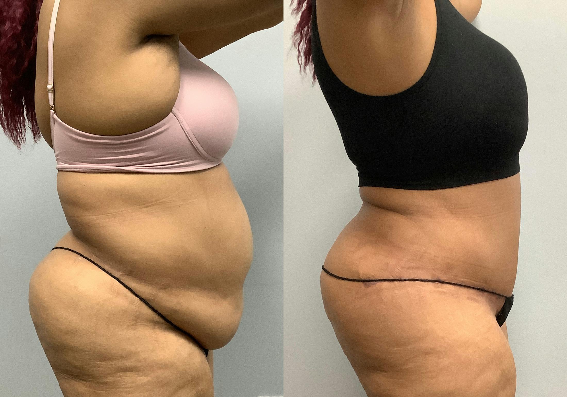 Tummy Tuck Before & After Gallery - Patient 147463806 - Image 3