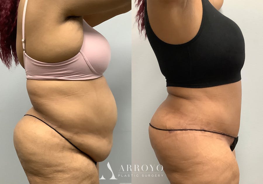 Tummy Tuck Before & After Gallery - Patient 147463806 - Image 3