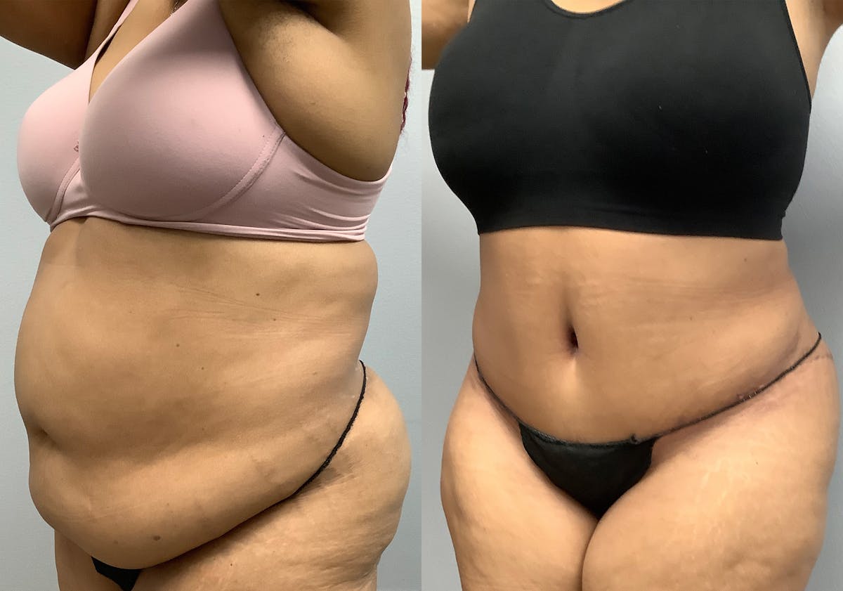 Tummy Tuck Before & After Gallery - Patient 147463806 - Image 4