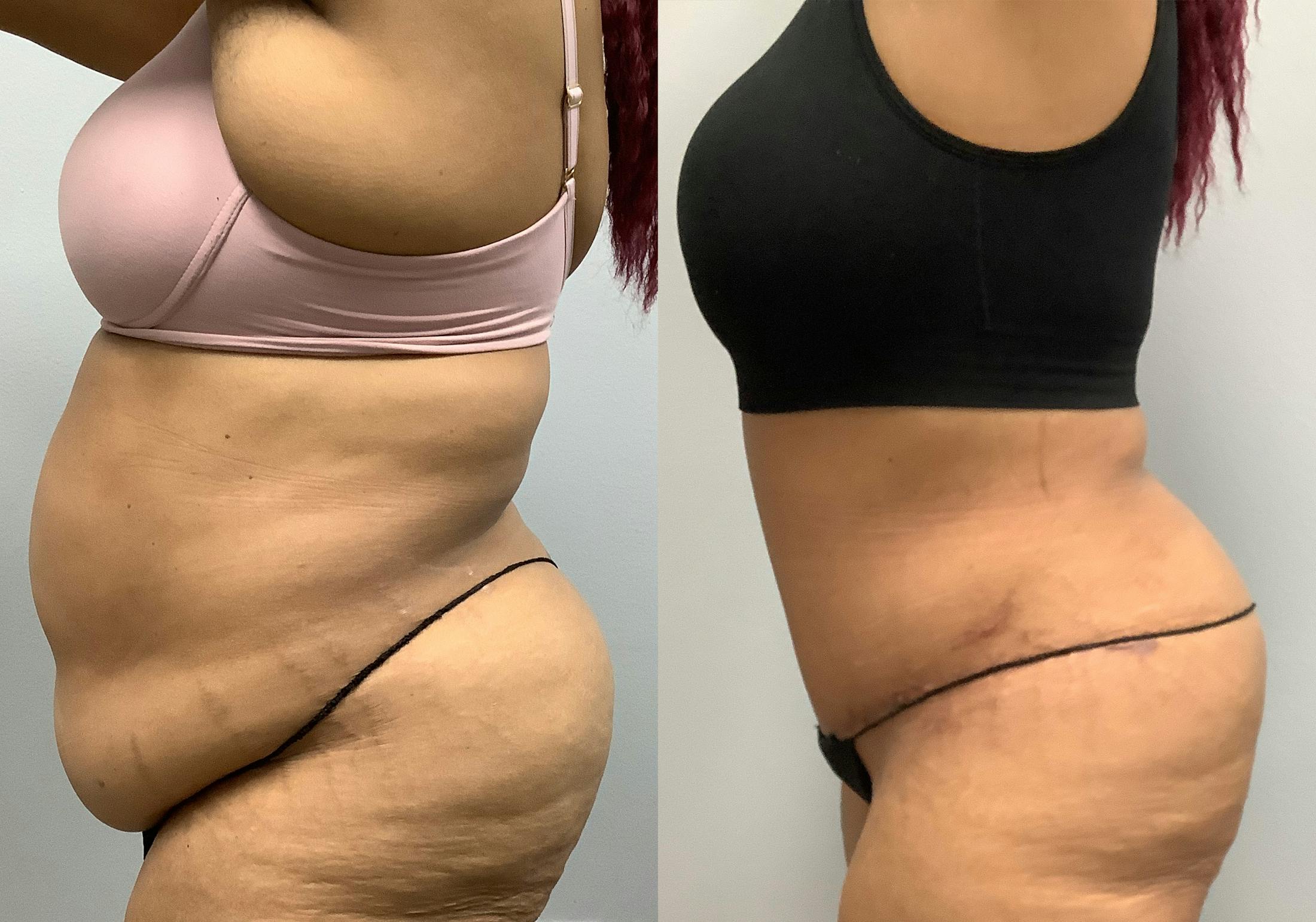 Tummy Tuck Before & After Gallery - Patient 147463806 - Image 5