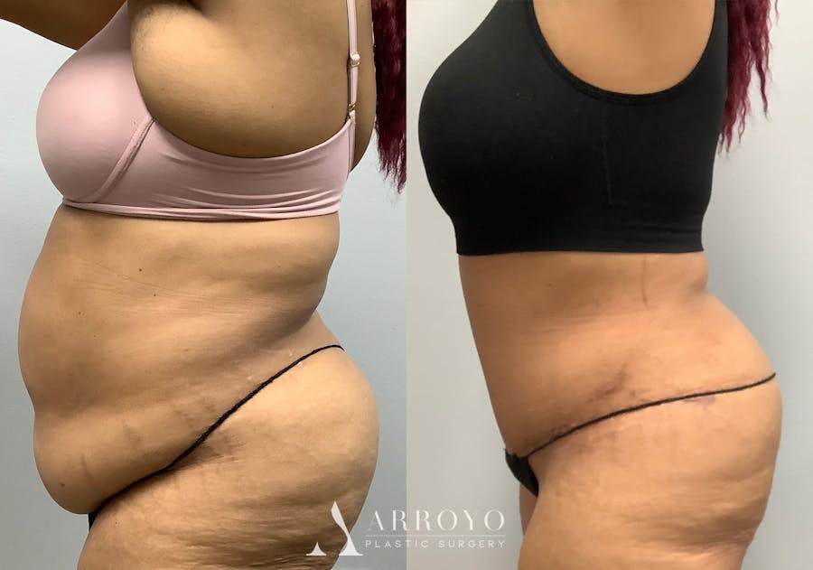 Tummy Tuck Before & After Gallery - Patient 147463806 - Image 5