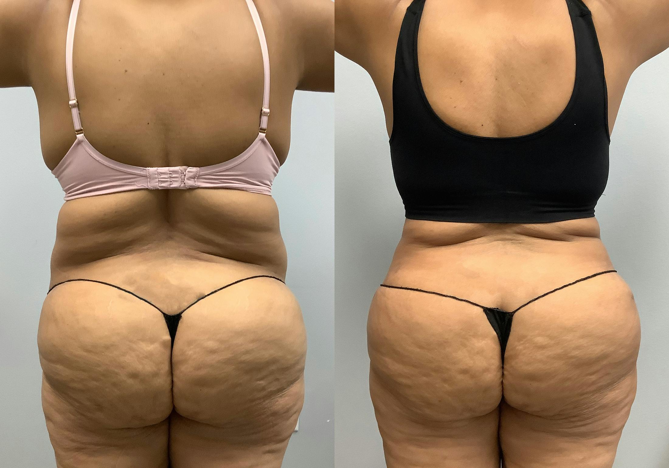 Tummy Tuck Before & After Gallery - Patient 147463806 - Image 6