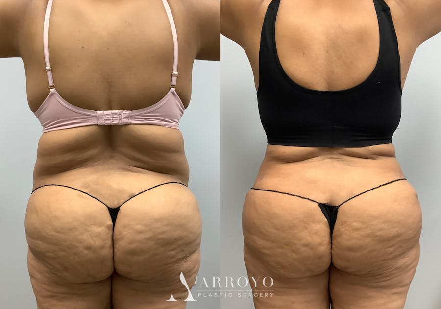 Tummy Tuck Before & After Gallery - Patient 147463806 - Image 6