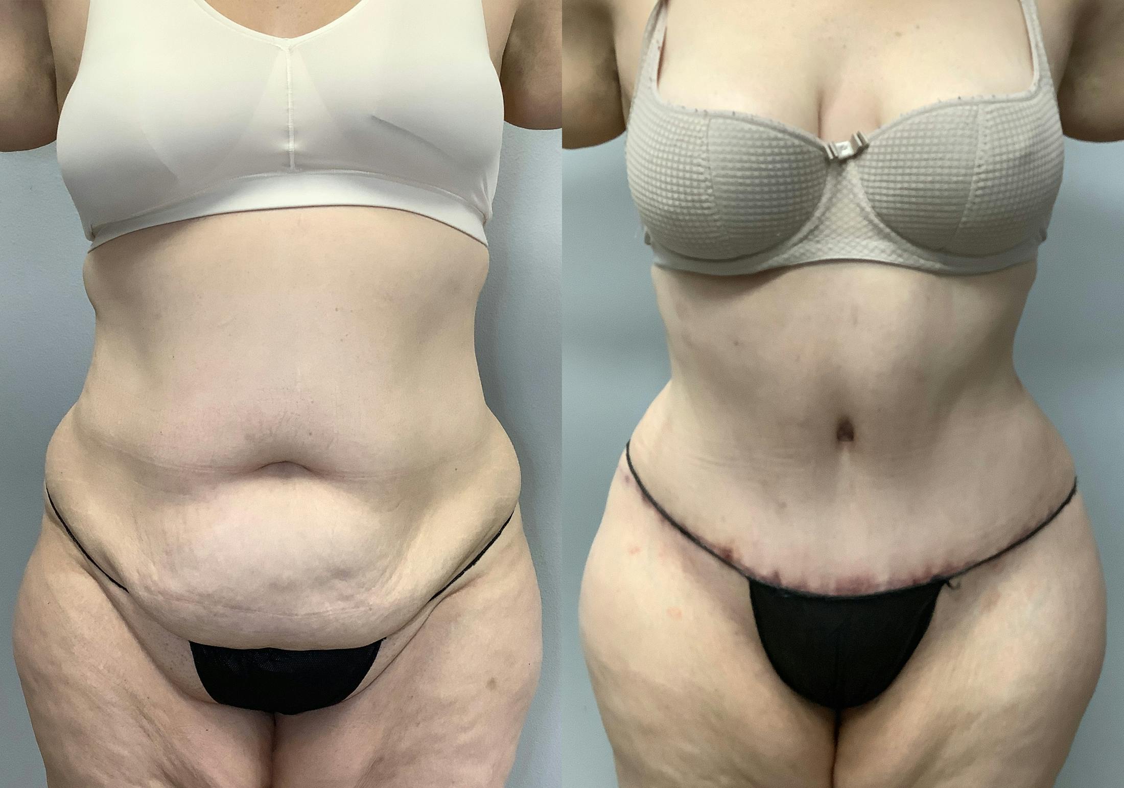 Tummy Tuck Before & After Gallery - Patient 147463773 - Image 1