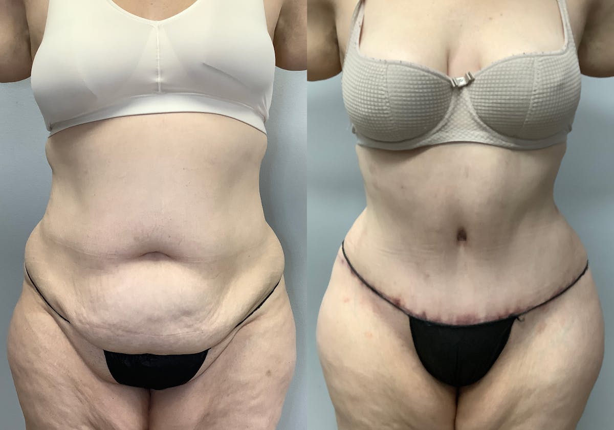 Tummy Tuck Before & After Gallery - Patient 147463773 - Image 1