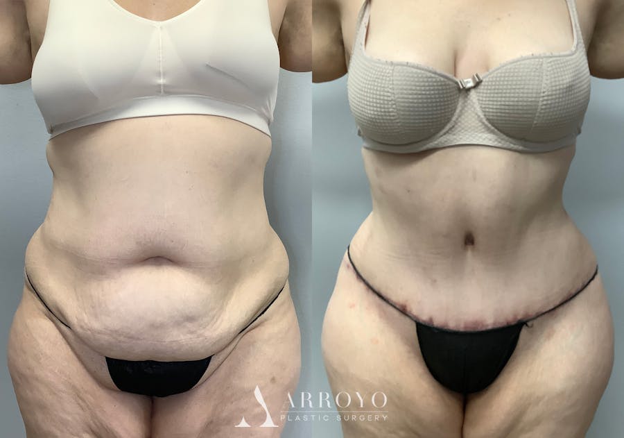Tummy Tuck Before & After Gallery - Patient 147463773 - Image 1