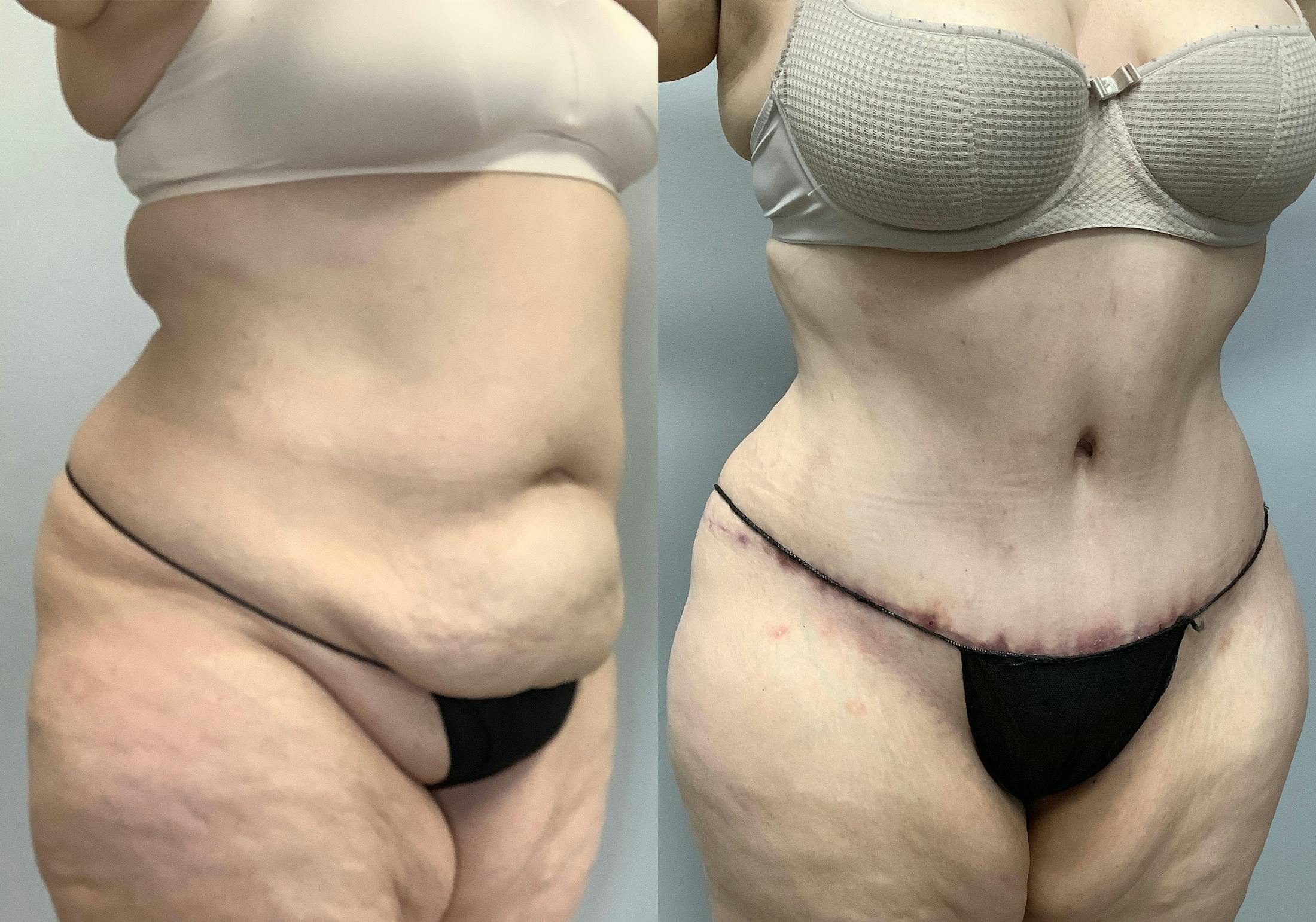 Tummy Tuck Before & After Gallery - Patient 147463773 - Image 2