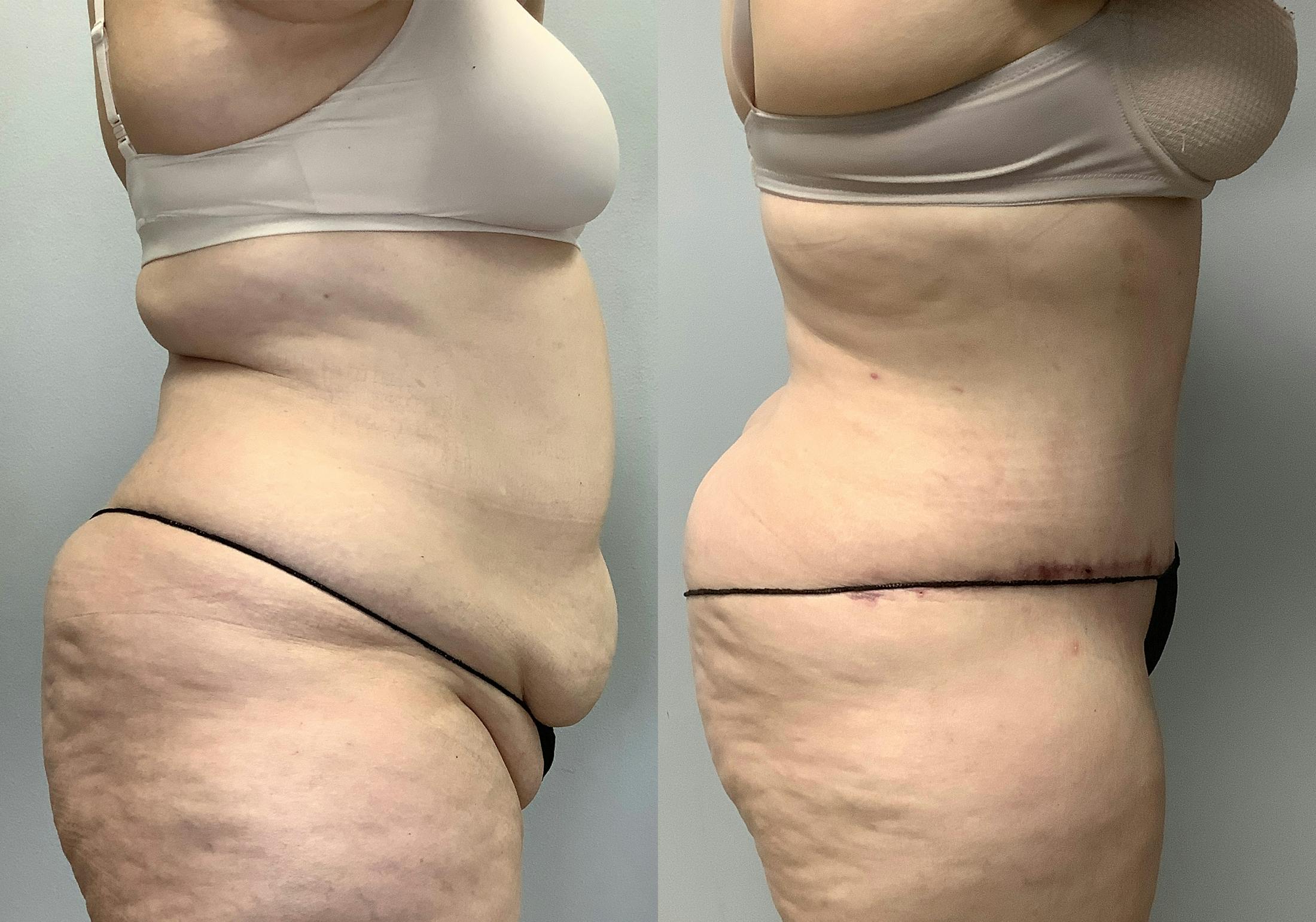 Tummy Tuck Before & After Gallery - Patient 147463773 - Image 3