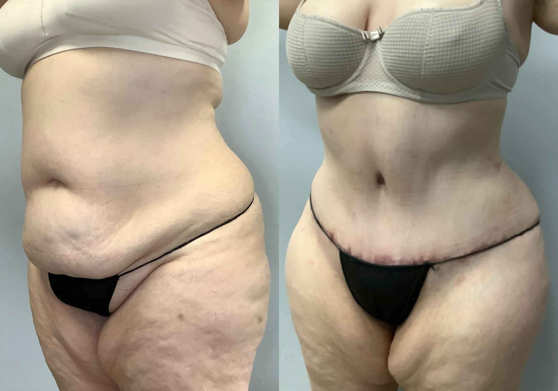 Tummy Tuck Before & After Gallery - Patient 147463773 - Image 4