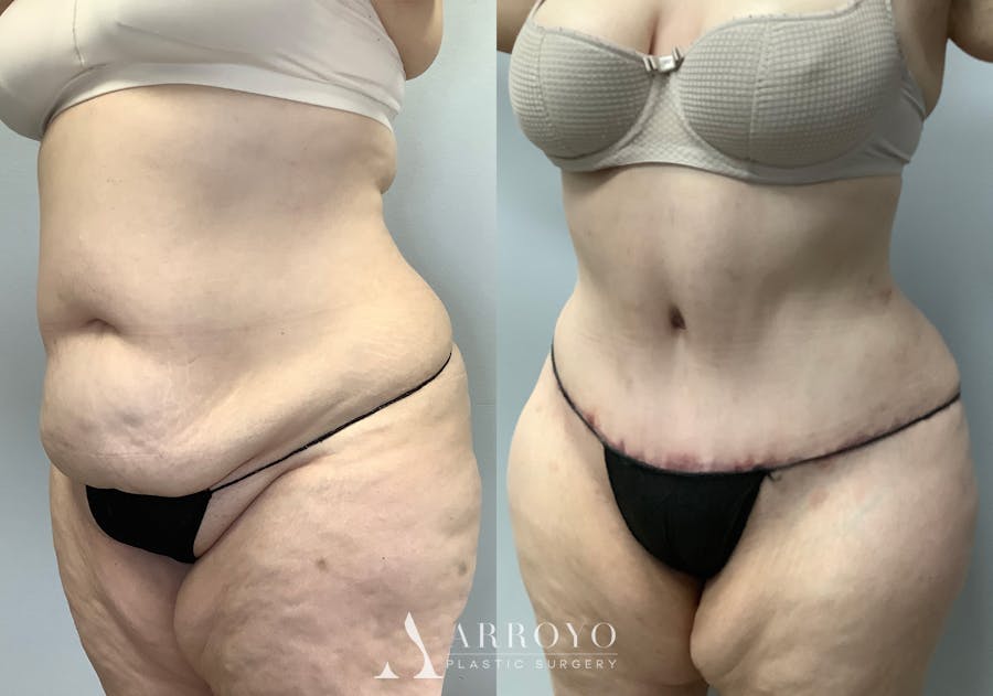 Tummy Tuck Before & After Gallery - Patient 147463773 - Image 4