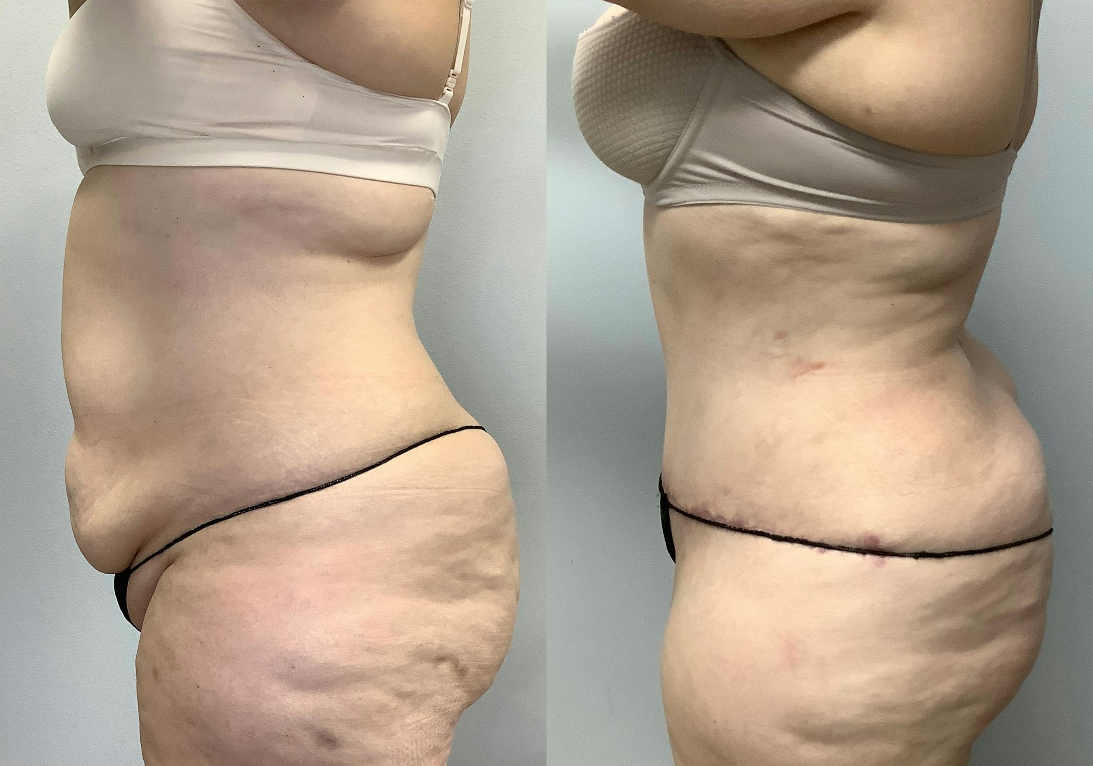 Tummy Tuck Before & After Gallery - Patient 147463773 - Image 5
