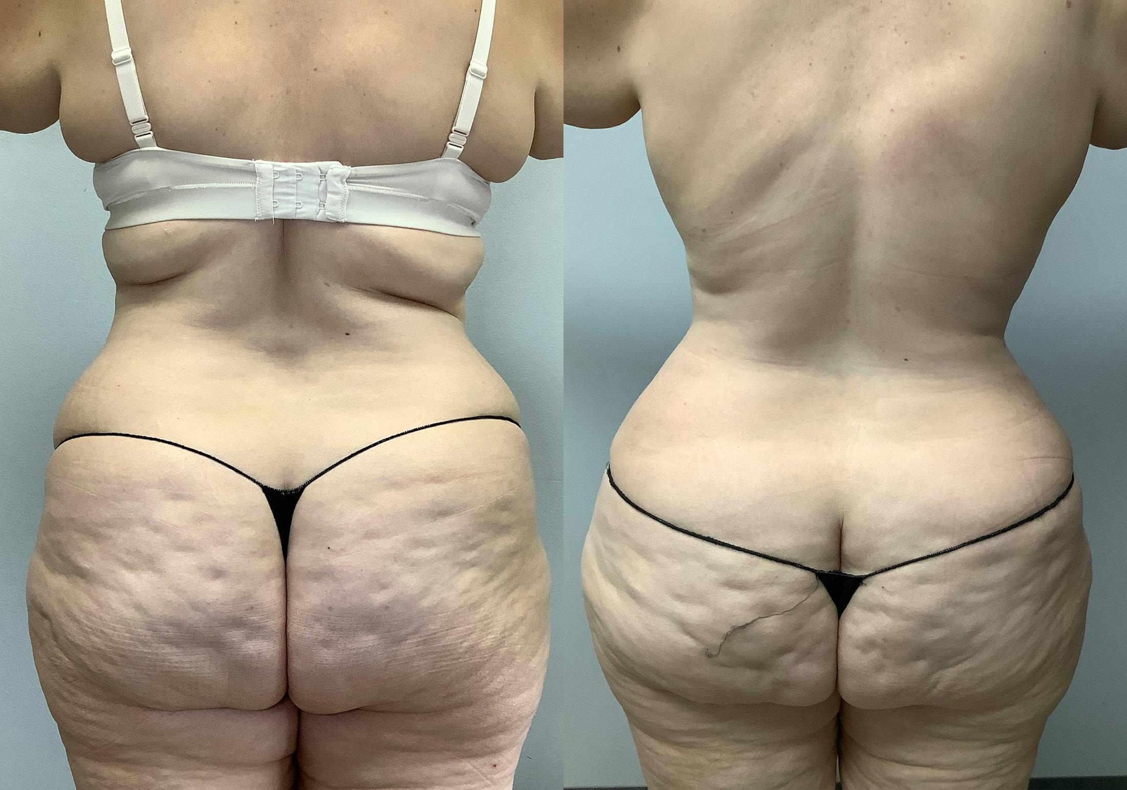 Tummy Tuck Before & After Gallery - Patient 147463773 - Image 6